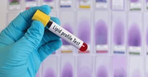 lipid profile test