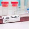 Lipid Profile Test: Understanding Good vs Bad Cholesterol