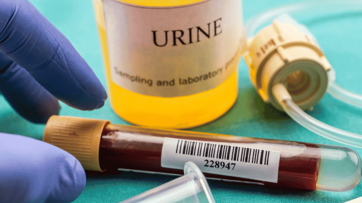Why a Urine Test Is Important for Your Health