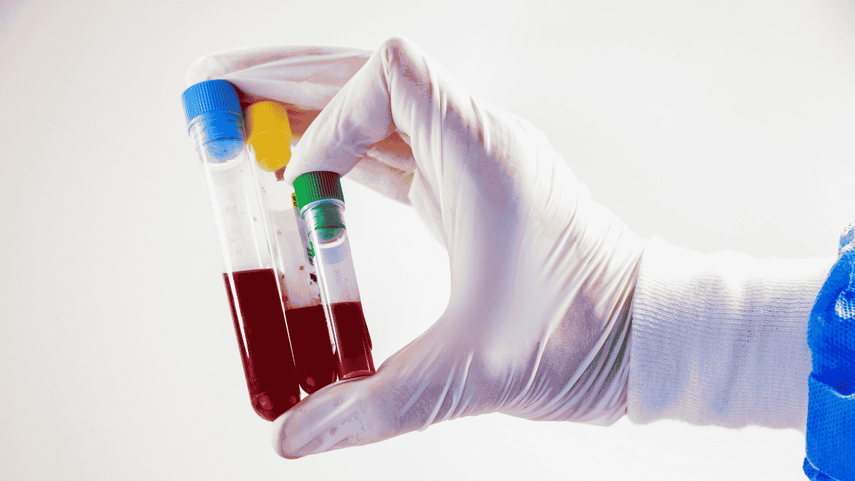 Blood Tests for Hair Fall Vitamin Deficiency Tests