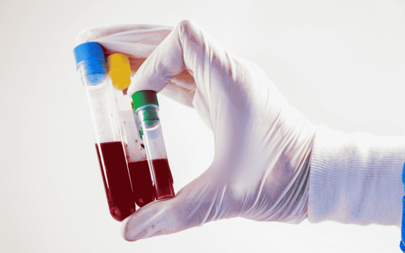 Blood Tests for Hair Fall Vitamin Deficiency Tests